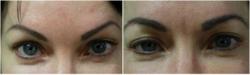 eyebrow transplant